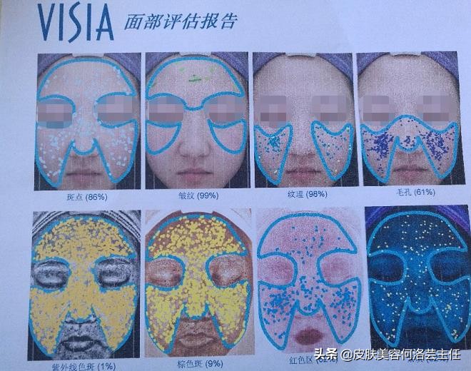 visia皮肤检测仪,visia皮肤检测报告数值越大越好吗