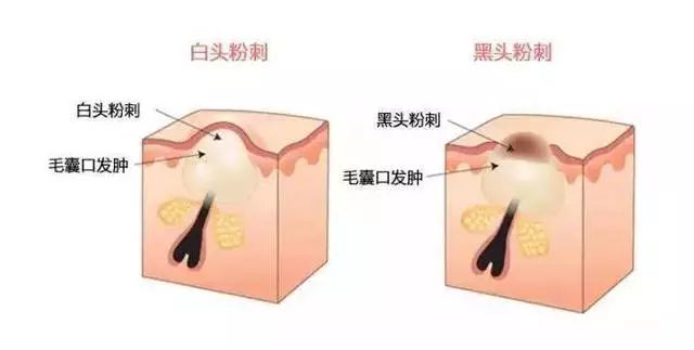 下巴闭口粉刺怎么可以有效的去除,痘痘粉刺闭口怎样护肤