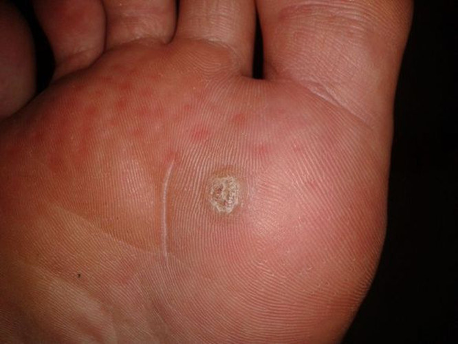 脚上长鸡眼有什么特征,脚上长了鸡眼如何防止感染