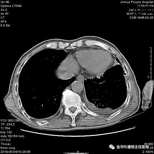 手术引起乳糜胸,有没有做了肺结节手术后是误诊的