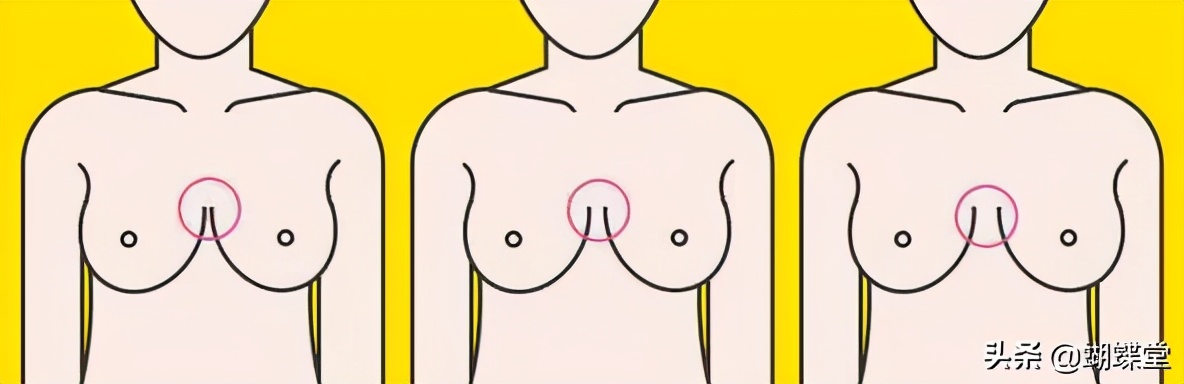 蝴蝶堂|胸部外扩，不止看起来那么简单