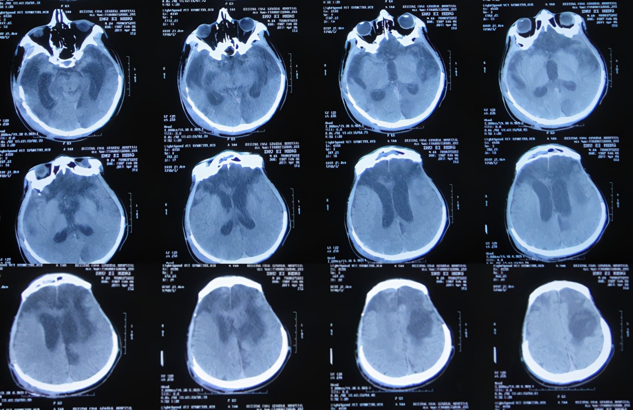 脑受伤开颅手术昏迷,开颅手术后20天发生脑积水引流