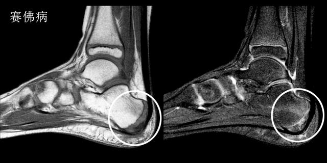 产后足跟痛是什么原因引起的,足跟痛是什么原因用什么贴