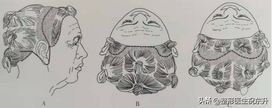 面部除皱大切口视频,除皱术的切口