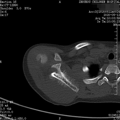 家长要警惕孩子腺样体面容,家长应该警惕孩子出现异常