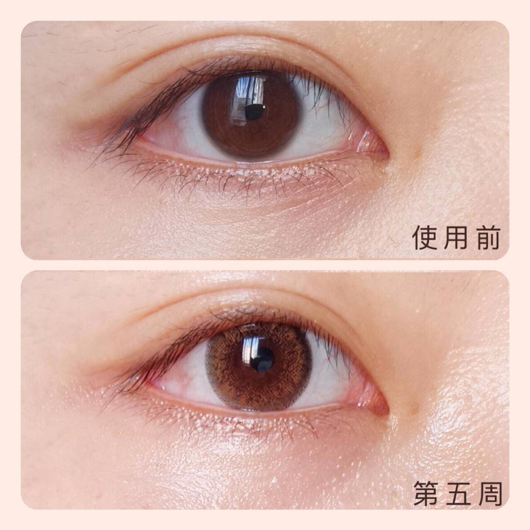 眼部有细纹用眼膜有用吗,眼部细纹眼膜有用吗