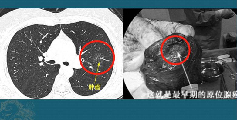 查出磨玻璃肺结节心里慌，该怎么做才保险？参考一下这6个