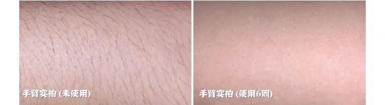 j-style脱毛仪怎么用,j-style脱毛仪怎样