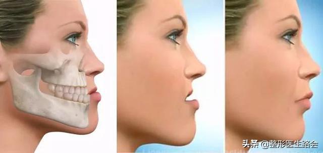 面中部凹陷下巴微翘,朱元璋式下巴怎么矫正