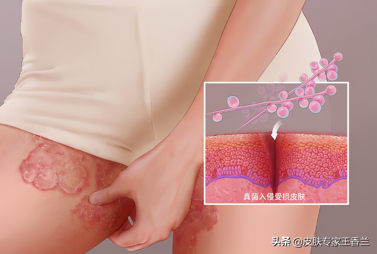 天气变暖身上就起癣是怎么回事,体癣天气越冷越严重
