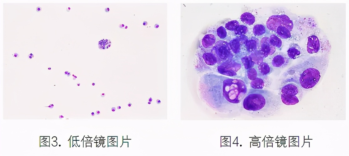 支气管肺泡灌洗液检测技术规范,肺泡灌洗液肿瘤细胞检查准确性