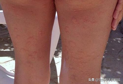 入秋宝宝皮肤突然干燥泛红有疙瘩,小孩手痒脱皮的原因和治疗方法