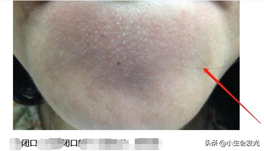 闭口怎么形成的怎么去,闭口一般是怎么形成的