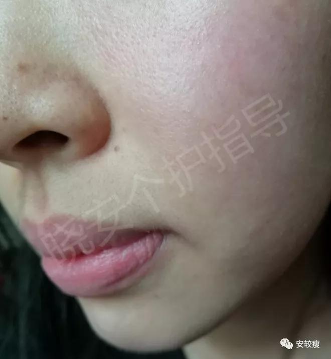 皮炎疹子干燥泛红,秋冬皮肤泛红发烫