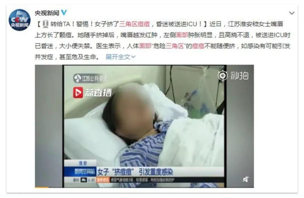 痘痘可以挤吗正确处理方法告诉你,教你正确的挤青春痘的方法