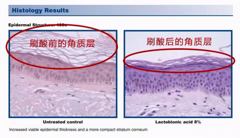 水杨酸30%刷几次有明显效果,水杨酸刷酸真的有用吗