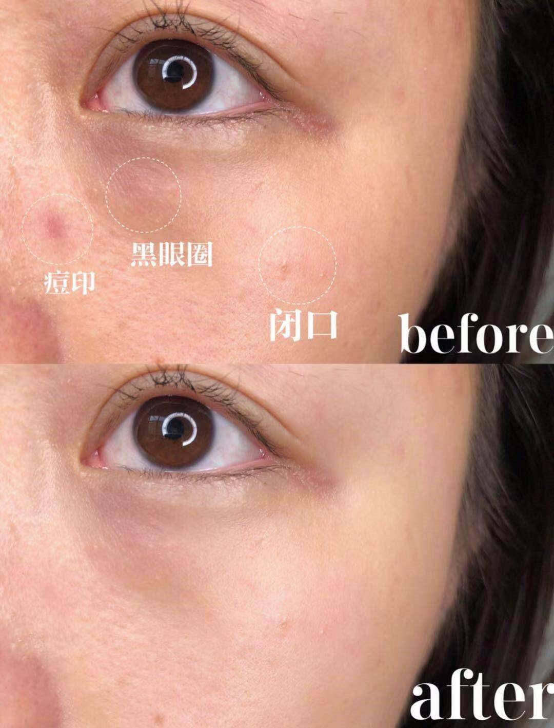 刷酸到底好不好,美容刷酸的副作用是什么