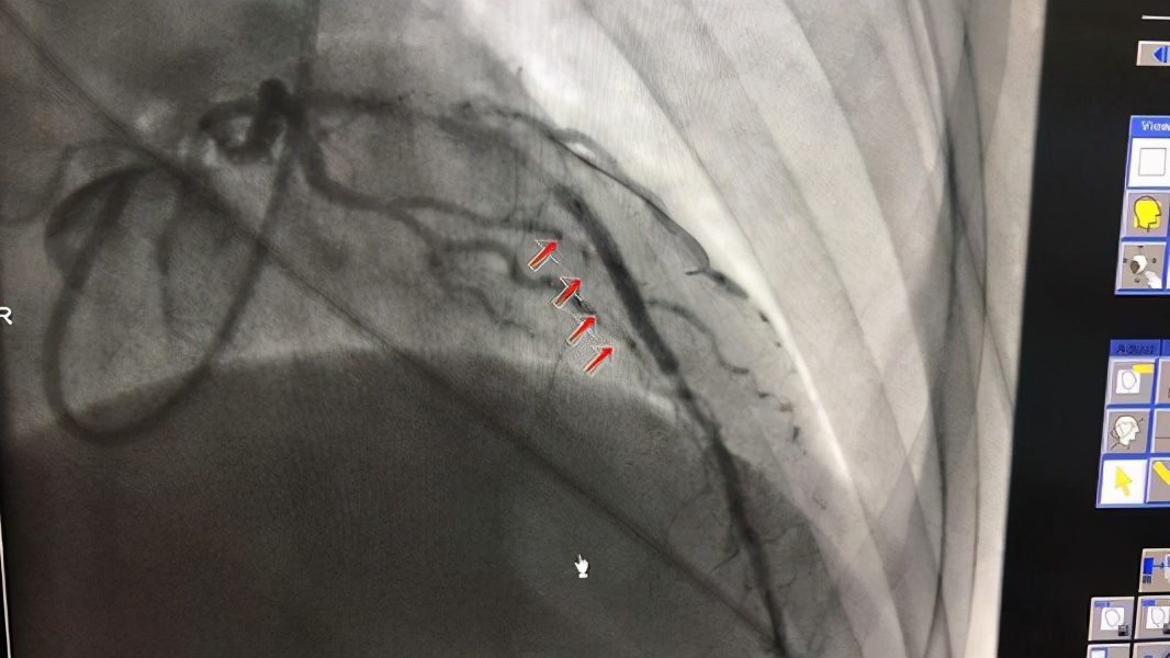 阵发性心动过速可出现呼吸困难，心绞痛，心率过快患者需改善体质