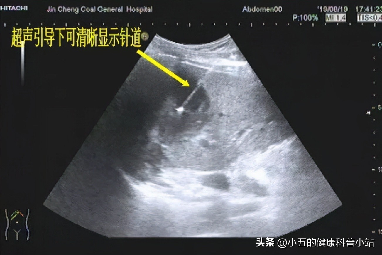 肝脏囊肿的症状和治疗方法,肝脏囊肿属于慢性病变吗