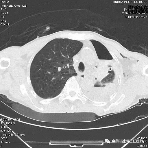 手术引起乳糜胸,有没有做了肺结节手术后是误诊的