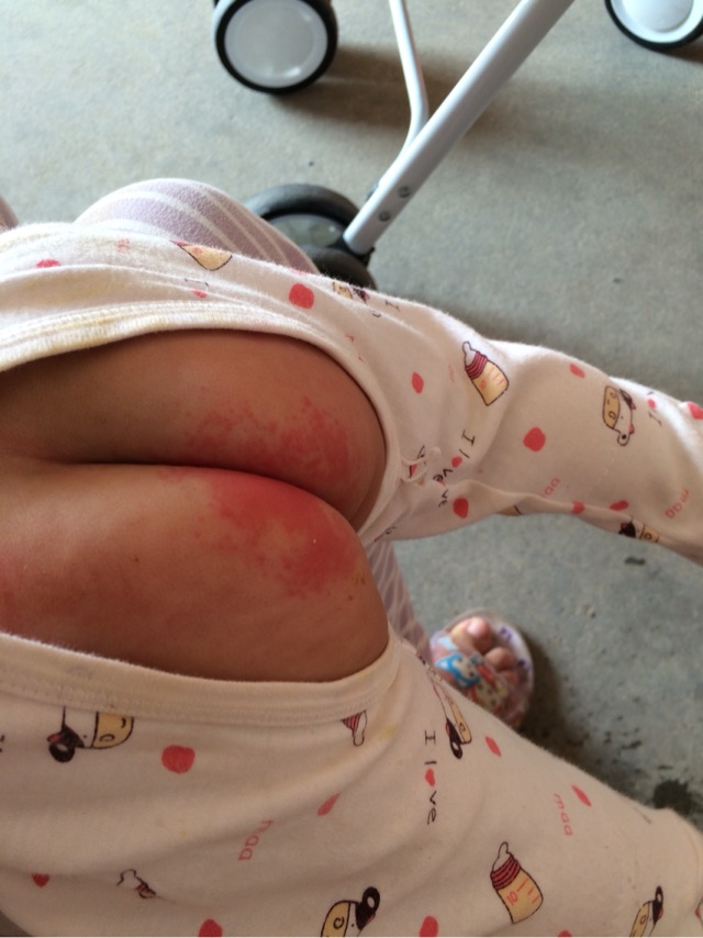 宝宝红屁股的救星,宝宝红屁股怎么办课件