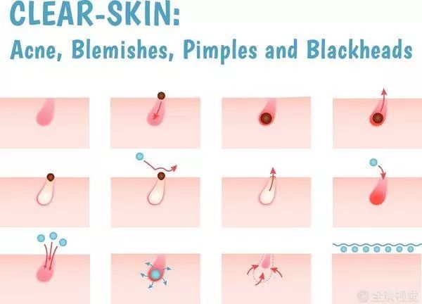 祛黑头甲硝唑凝胶和壬二酸怎么用,黑头用甲硝唑凝胶也搞不掉怎么办