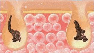 别挤了教你去黑头的正确方法,黑头用黑头膏为什么去不掉黑头