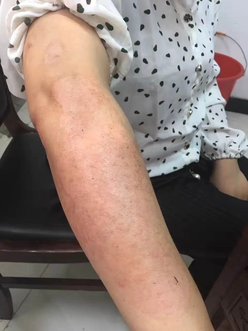 黄芪桂枝配伍的经方,黄芪桂枝五物汤治老年皮肤瘙痒症