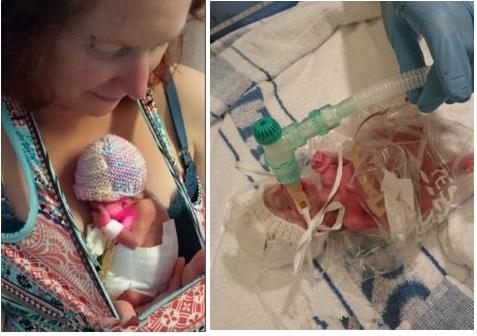 早产将近3个月，新生儿体重仅0.99斤却仍顽强存活，不禁让人感叹