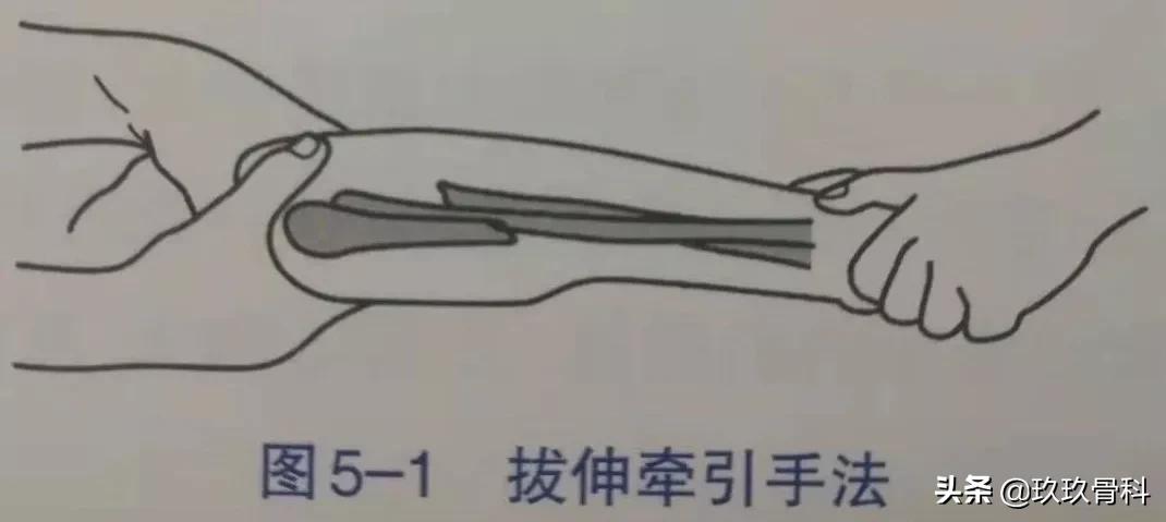 骨折手法整复术多少钱,骨折恢复手法视频教程