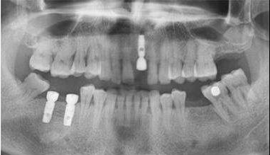 做种植牙周期需要多久,做种植牙的流程