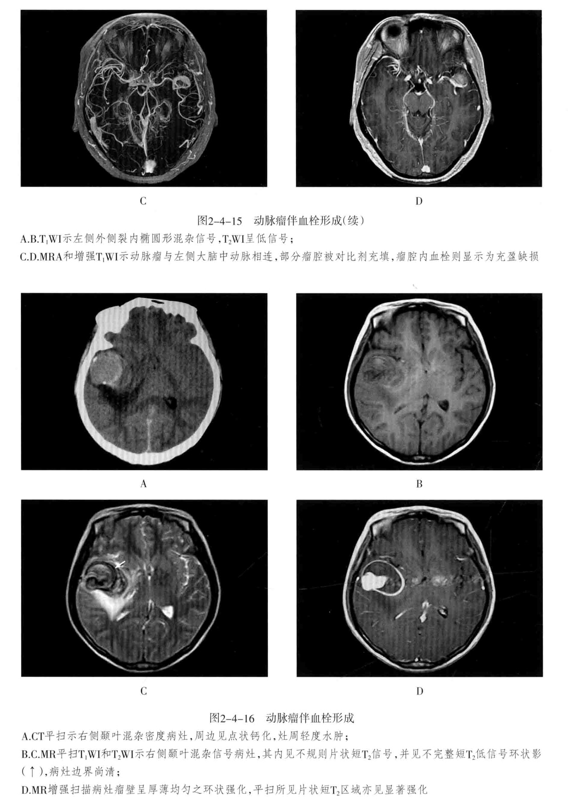 颅内血管轻度狭窄诊断标准,颅内血管先天变异影像