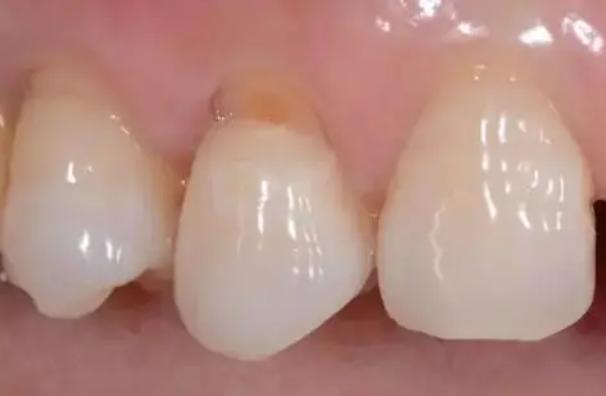 牙龈萎缩刷牙疼痛怎么办,牙龈萎缩刷牙就出血有办法治吗