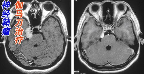 放疗与化疗有没有区别,放疗和化疗的区别到底有多大