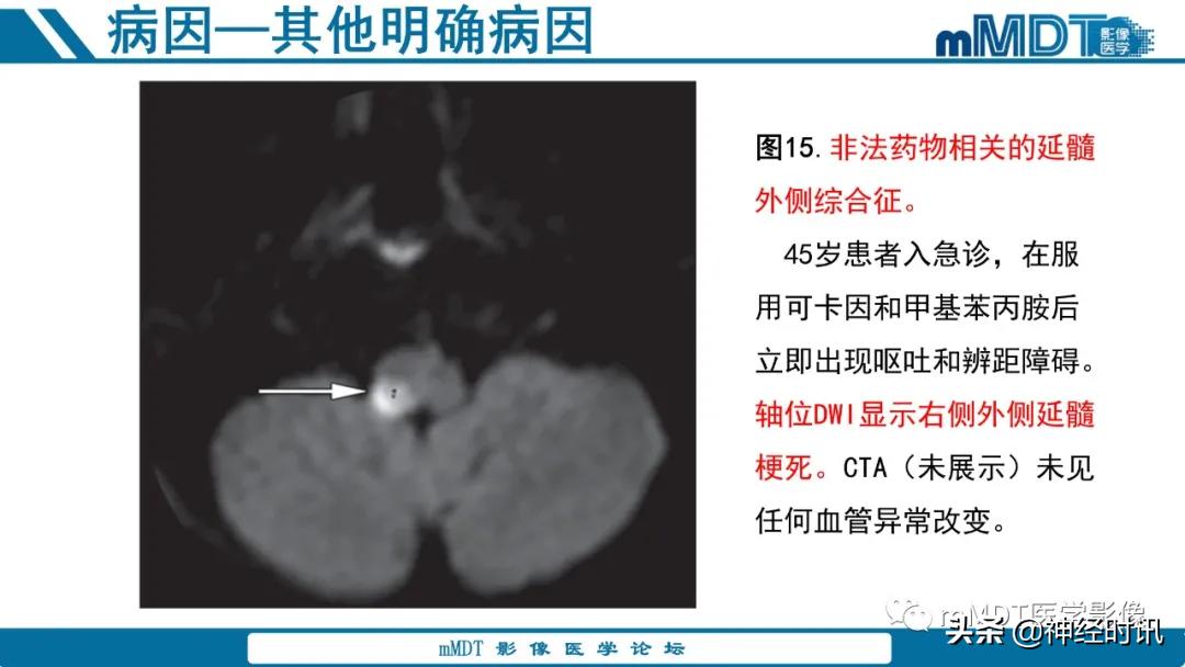 缺血性脑卒中护理课件,缺血性脑卒中讲课ppt