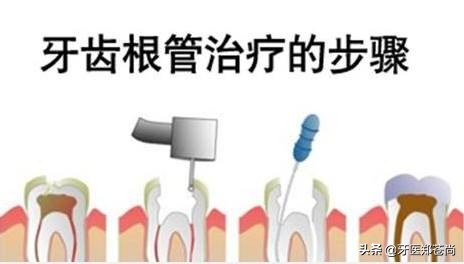 做了根管治疗的牙能矫正吗,根管治疗的牙还能用三十年吗