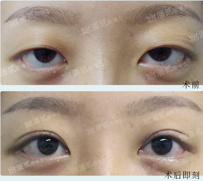 下三白眼长大后会改善吗,下三白眼的人如何手术矫正