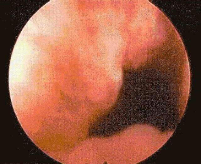 胆囊结石的危害和治疗方法,胆囊结石多大需要治疗