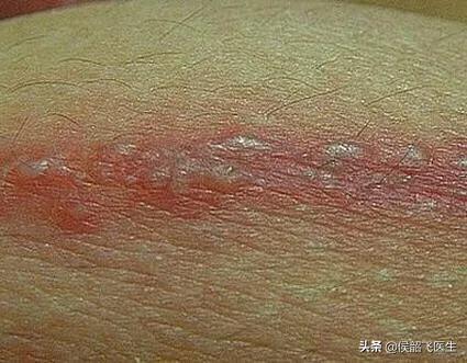 地塞米松护理口诀,侯医生讲座视频