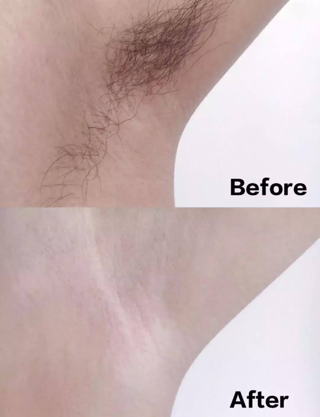 史上最实用脱毛术!夏天再也不为这事发愁啦