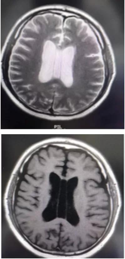 脑室透明隔间腔,第五脑室是什么意思