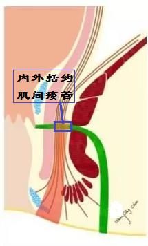 肛瘘lift手术天津哪有医院使用,北京哪家医院能做lift肛瘘手术