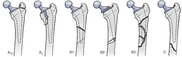 髋部骨折危害大老年人摔伤要重视,髋部骨折的最简单方法