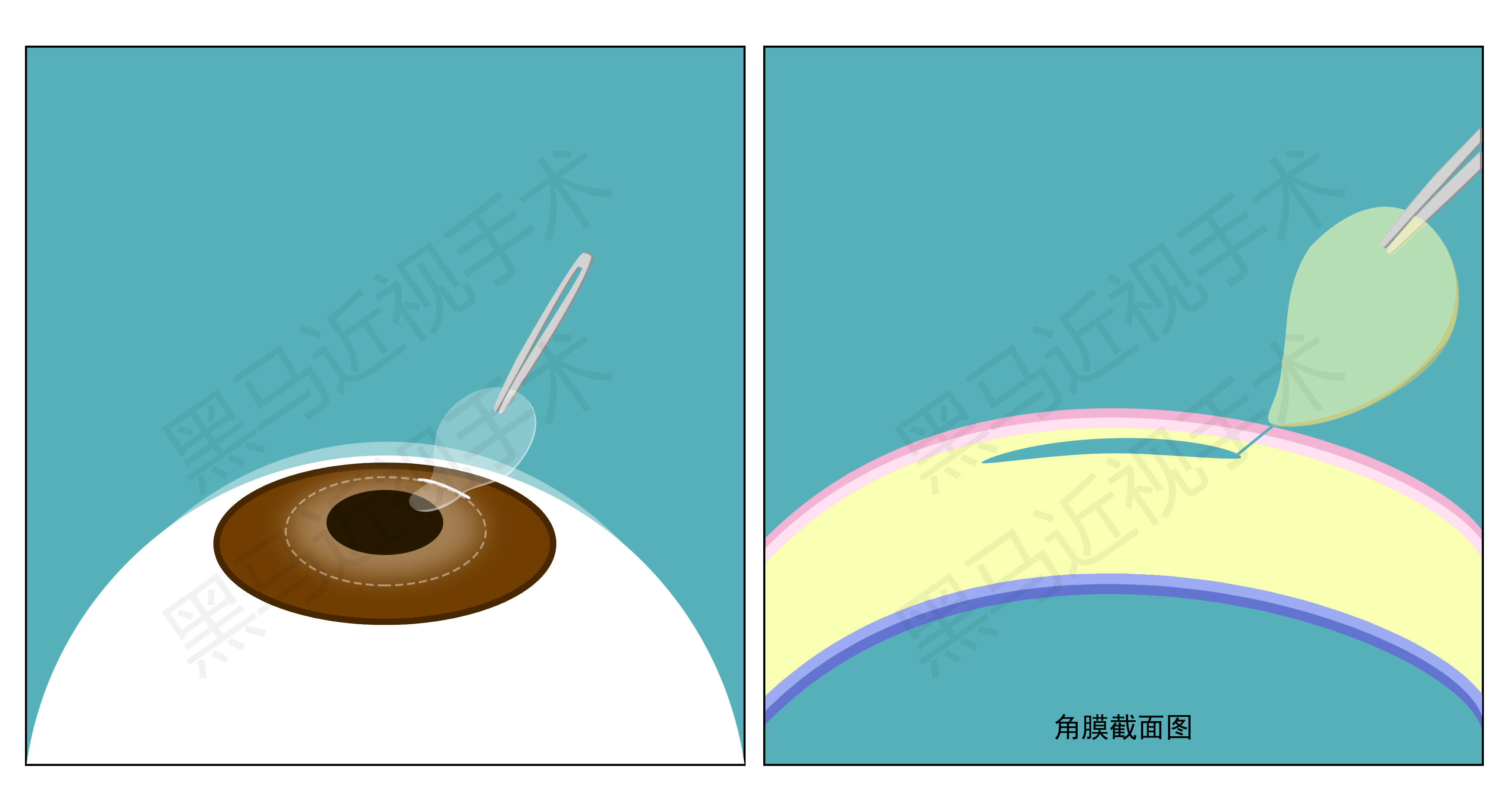 激光近视矫正手术有什么后遗症,激光治疗近视安全啊有没有后遗症