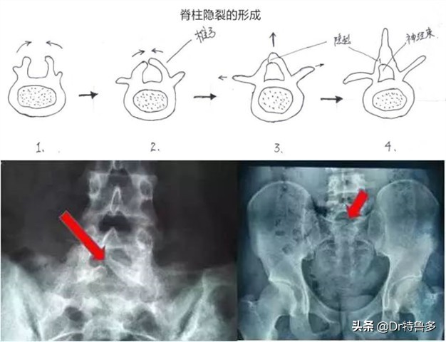 青少年腰痛，小心误诊，也有可能是得了一种“老人病”