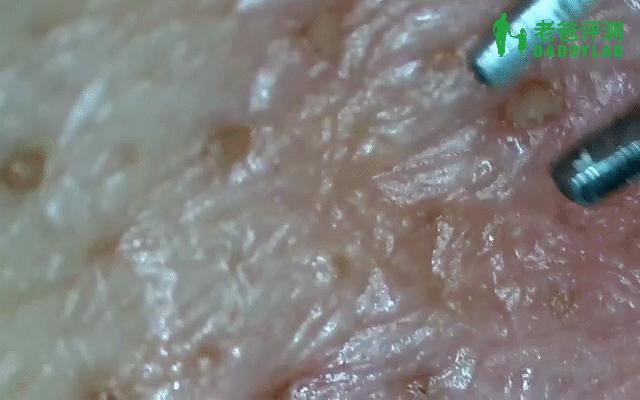 黑头怎么从根部去除,黑头到底怎么去