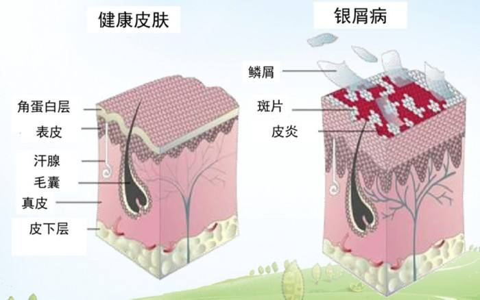 青岛治疗银屑病最好的方法,章丘治银屑病最好的方法