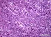 魏则西细胞疗法,魏则西滑膜肉瘤原发部位在哪