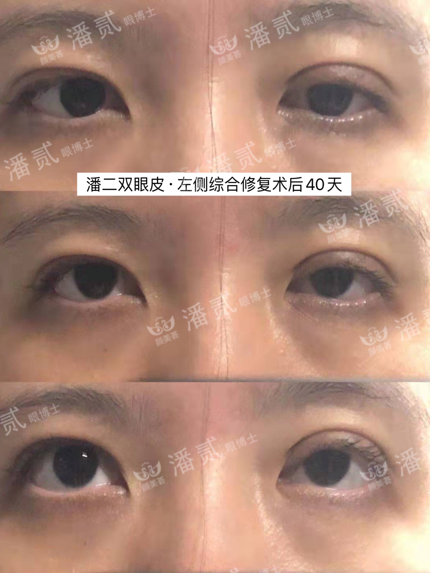 双眼皮手术后问题,双眼皮术后怎么才知道恢复好了没