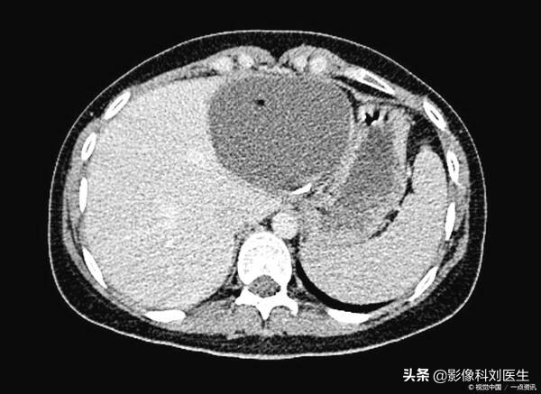 请问专家肝囊肿是什么意思,得了肝囊肿该怎么预防